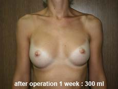 plastic-surgery-breast-augmentation 
